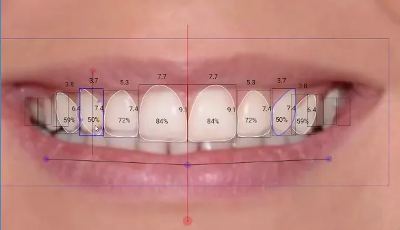 Primo piano di una bocca sorridente con misure digitali e percentuali sovrapposte ai denti, per evidenziare l'analisi dentale presso odontoiatria-estetica-coppede-medical-hub-roma.