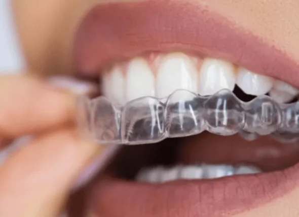 Primo piano di una persona che posiziona un allineatore dentale trasparente sui denti superiori, per mostrare l'ortodonzia-invisibile presso il Coppede Medical Hub Roma. Primo piano di una persona che posiziona un allineatore dentale trasparente sui denti superiori, per mostrare l'ortodonzia-invisibile presso il Coppede Medical Hub Roma.